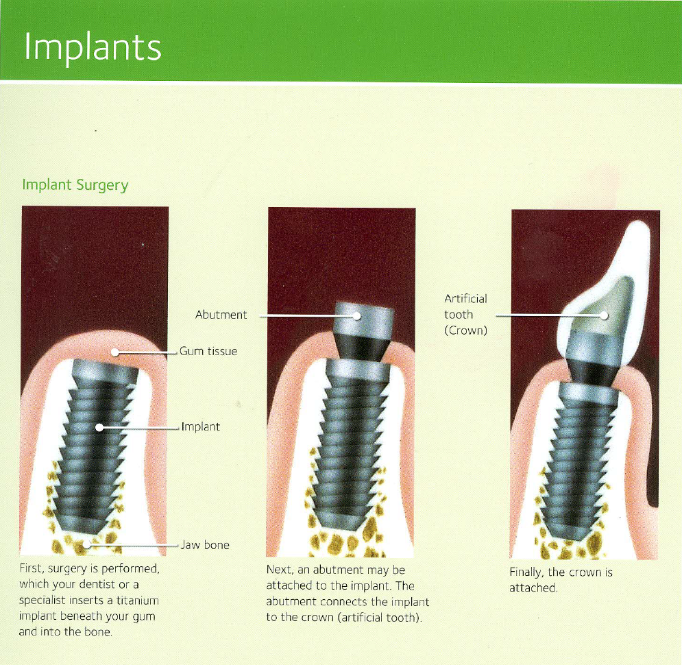 implants