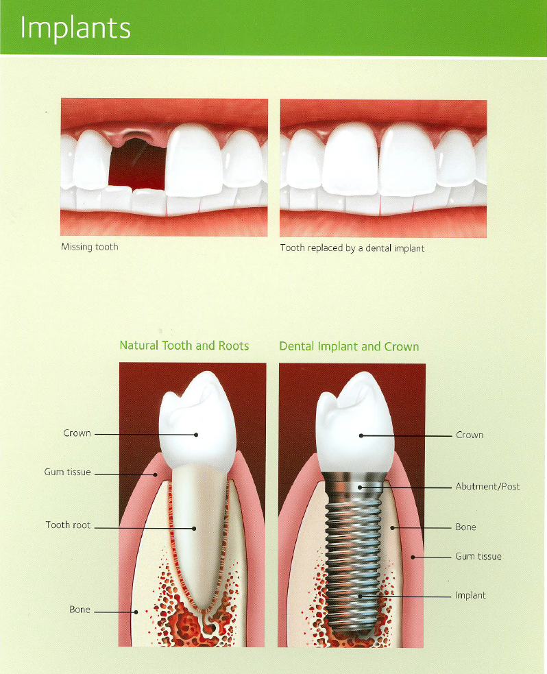 implants2