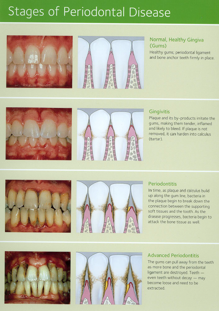 periodontal